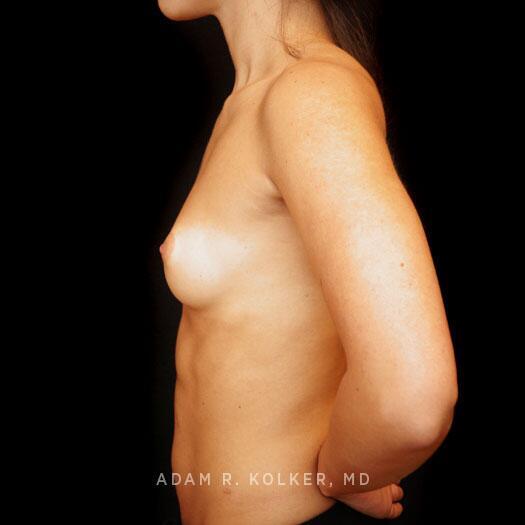 Breast Augmentation Before Image Patient 82 Side View
