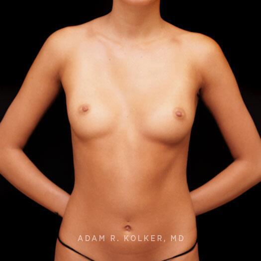 Breast Augmentation Before Image Patient 99 Front View