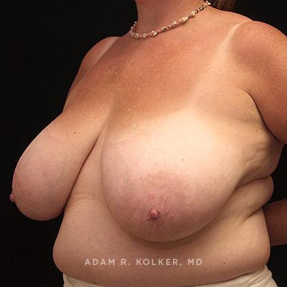 Breast Reduction Before Image Patient 04 Oblique View